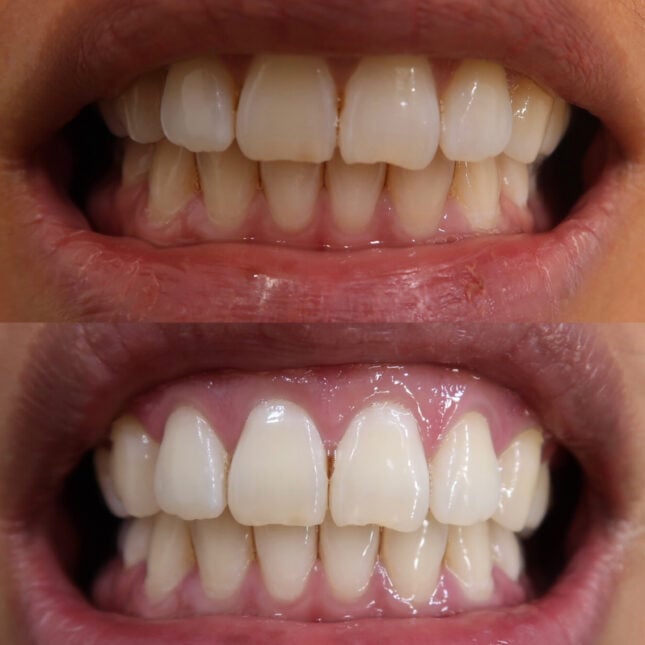 Double Whitening 2 | The Smile Bar