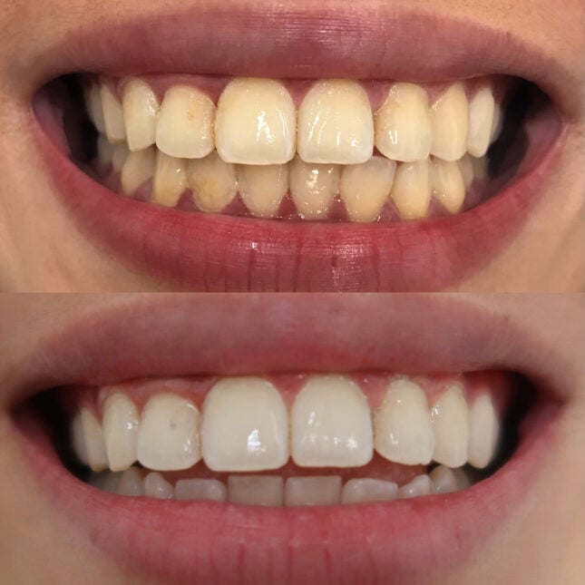 Double Whitening 1 | The Smile Bar