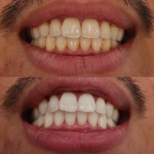 Triple Whitening 2 | The Smile Bar