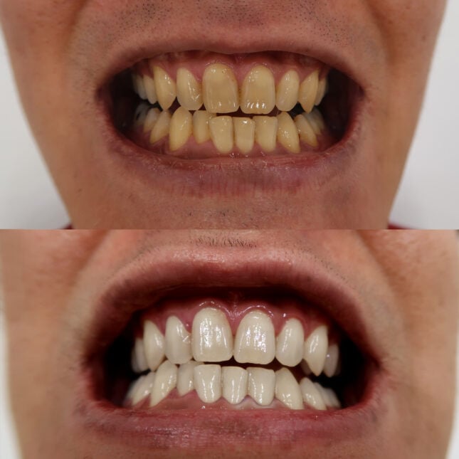 Triple Whitening 3 | The Smile Bar