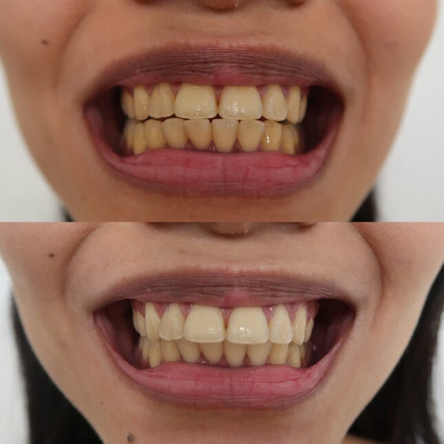 Single Whitening 4 | The Smile Bar